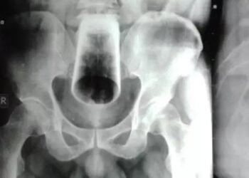 Homem passa por cirurgia após ficar 3 dias com copo preso no ânus