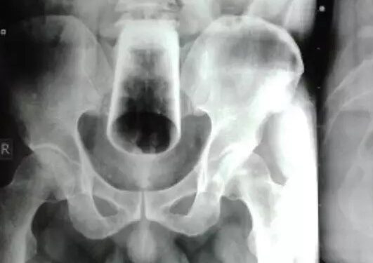 Homem passa por cirurgia após ficar 3 dias com copo preso no ânus