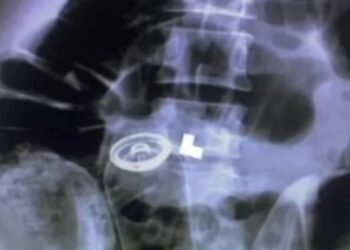 Homem passa por cirurgia de emergência após inserir desodorante em seu ânus