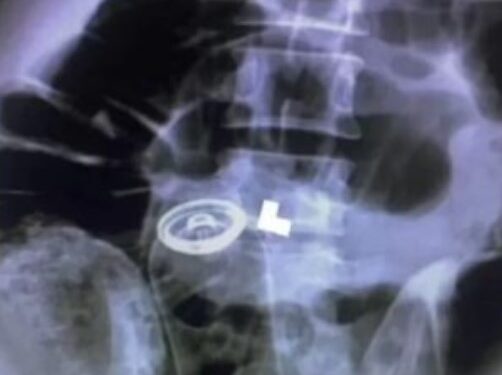 Homem passa por cirurgia de emergência após inserir desodorante em seu ânus