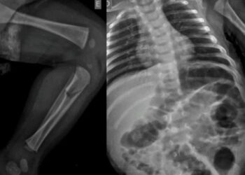 Casal é preso por suspeita de tentativa de homicídio contra bebê de 40 dias