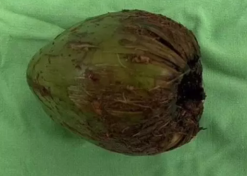 Homem passa por cirurgia para remover coco que inseriu no ânus