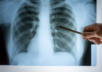 Saúde de Curitiba faz alerta sobre os cuidados para prevenir a tuberculose