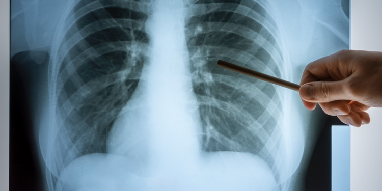 Saúde de Curitiba faz alerta sobre os cuidados para prevenir a tuberculose